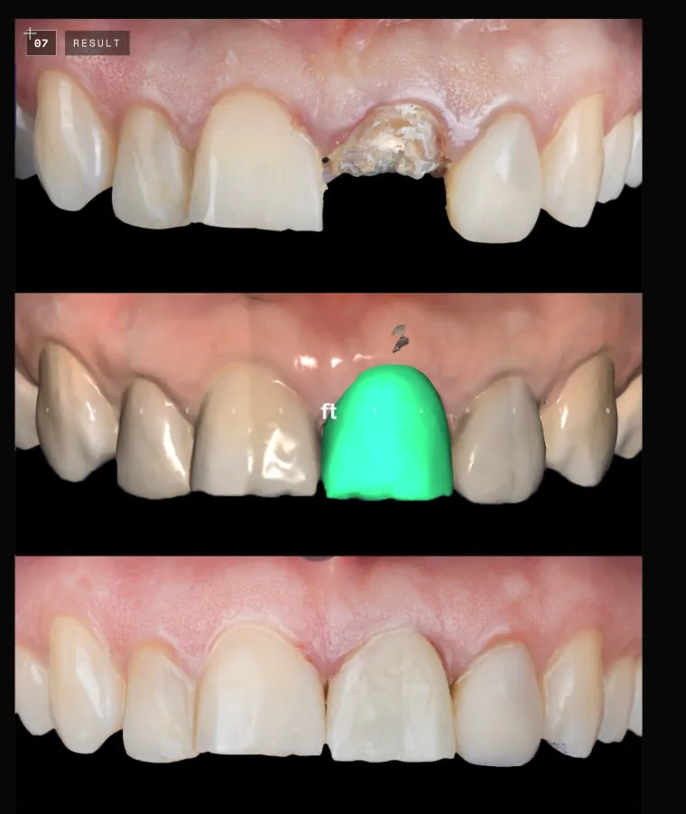 Immediate implant — maxillary central incisor