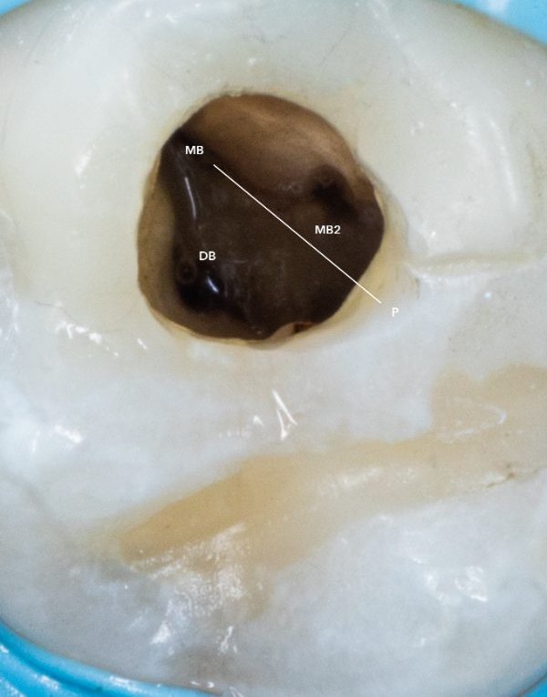 MB2 retreatment — pulp chamber floor mapped
