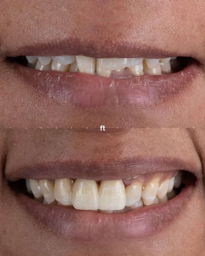 Three-Unit Bridge In-House Zirconia
