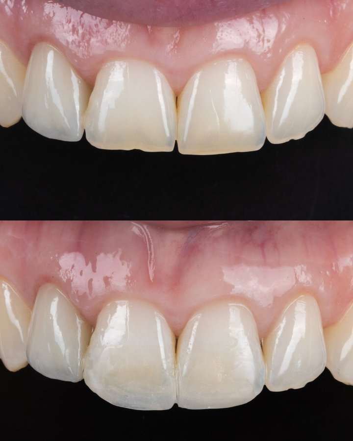 Central Incisors 8:10 Proportion