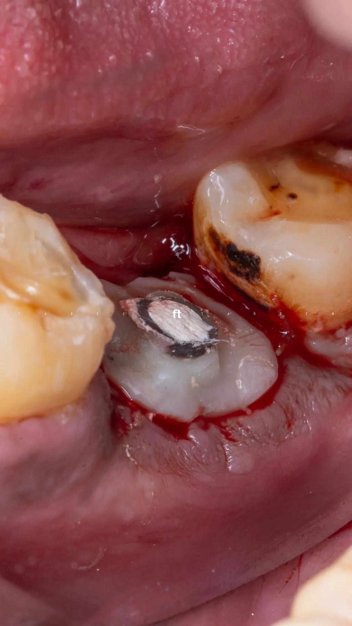 Immediate implant with socket seal