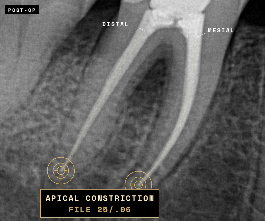 Mandibular first molar root canal, post-operative periapical with the apical constriction marked